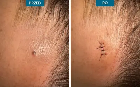 Przed i po zabiegu usuwania narośli skórnych. Widoczne blizny po chirurgicznym usunięciu zmiany.