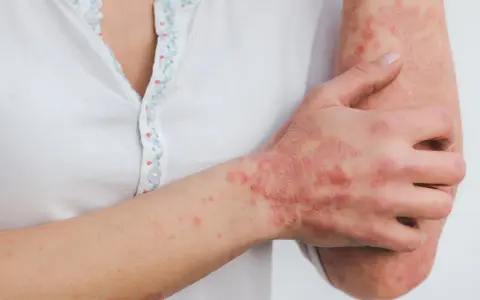 Ręka i przedramię z widocznymi, czerwonymi, swędzącymi zmianami skórnymi, które mogą wskazywać na łuszczycę lub inne schorzenia dermatologiczne.