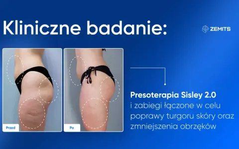 Przed i po zabiegu presoterapii. Widoczne wyraźne presoterapia efekty: poprawa jędrności skóry i redukcja obrzęków.