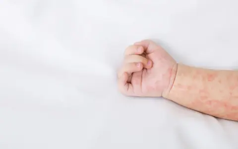 Drobne, czerwone plamki na rączce niemowlaka – widoczna wysypka u dziecka.