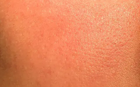 Pelle arrossata e secca, con piccole scaglie visibili, tipica di un'irritazione da retinolo.
