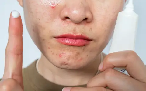 A person's face shows acne and redness, possibly from retinol burn. A finger with cream and a tube of skincare product are visible.