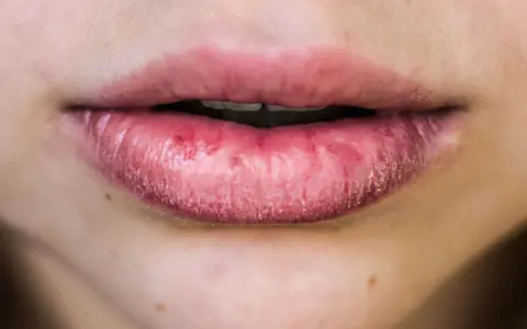 Labbra secche e screpolate, con segni di irritazione. Le cause possono essere molteplici, dal freddo alla disidratazione.