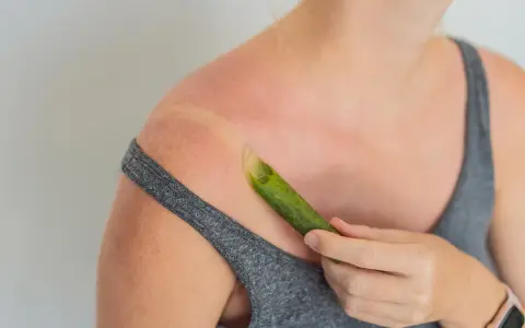 Spalla arrossata dal sole, con una foglia di aloe vera che lenisce le scottature.