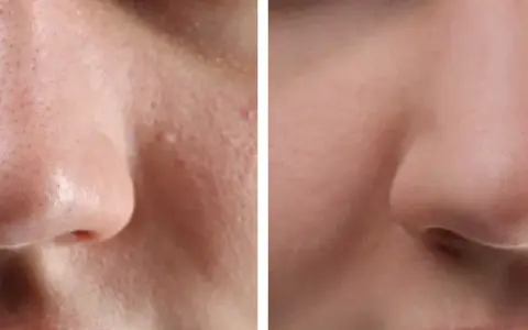 Avant/après : peau du nez avec points noirs avant et après extraction, montrant une peau plus lisse et nette.