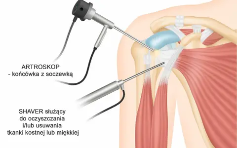 Artroskop i shaver w trakcie zabiegu barku, pomagające w diagnostyce i leczeniu bolesnego łuku.