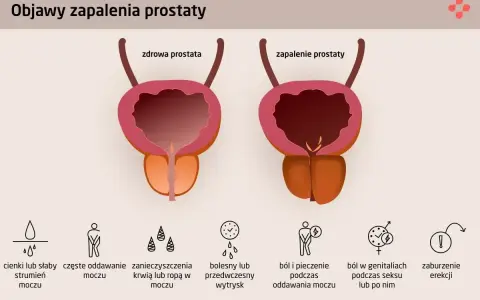 Ilustracja porównuje zdrową prostatę z zapaloną, pokazując objawy zapalenia prostaty: słaby strumień moczu, ból, pieczenie i zaburzenia erekcji.