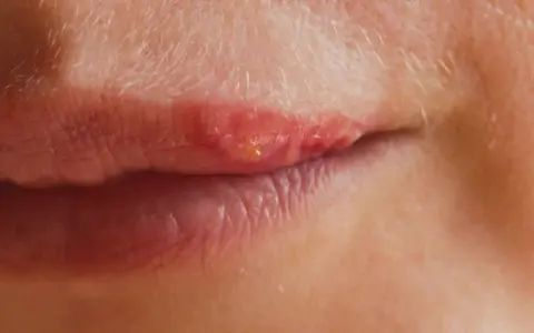 Gros plan sur une lèvre avec un bouton de fièvre rouge et enflammé, suggérant un traitement en cours.