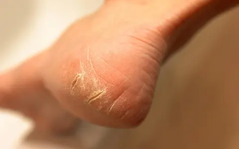 Gros plan sur un talon qui pele, la peau sèche et craquelée formant des sillons profonds.