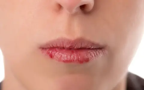 Popękane, suche usta z zaczerwienieniem. Szukasz domowych sposobów na suchość w ustach?