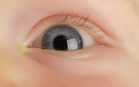 Roopiejące oko u niemowlaka, żółta wydzielina przy kąciku. Czas na wizytę u lekarza.