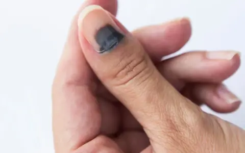 Gros orteil avec un hématome sous l'ongle, signe d'un traumatisme. La zone sombre indique le sang accumulé.