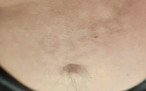 Widoczne brązowe plamy na brzuchu, z widocznym pępkiem i drobnymi włoskami.