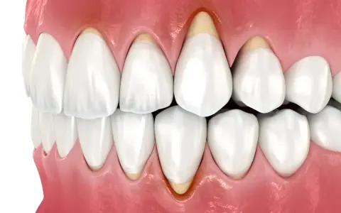 Zbliżenie na zęby i dziąsła, ukazujące odsłonięte korzenie zębów, co może być przyczyną tzw. gummy smile.