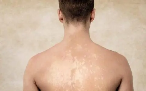 Dos de homme montrant des taches blanches sur la peau, possiblement dues à une exposition au soleil.