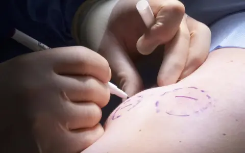 Chirurg markiert mit Stift die Stelle für die Lipomentfernung.