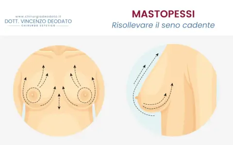 Mastopessi: solleva il seno cadente. Immagine illustra il seno prima e dopo il sollevamento, con frecce che indicano il movimento verso l'alto.