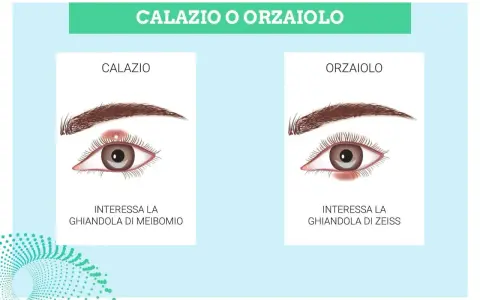Illustrazione che confronta calazio e orzaiolo. Il calazio interessa la ghiandola di Meibomio, causando un gonfiore.