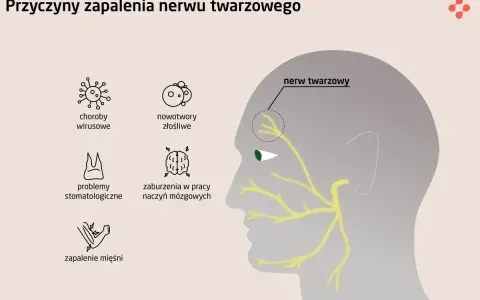 Ilustracja przedstawia przyczyny zapalenia nerwu twarzowego: choroby wirusowe, nowotwory, problemy stomatologiczne, zaburzenia naczyń mózgowych i zapalenie mięśni.