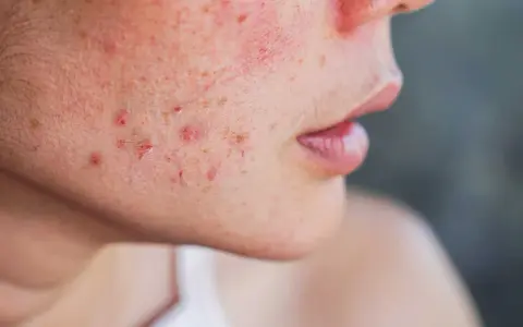 Gros plan sur une joue présentant des rougeurs et des boutons, symptômes d'acné rosacée.