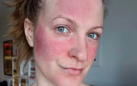 Frau mit stark geröteter Haut im Gesicht, möglicherweise Rosacea. Die Anwendung von Retinol kann hier eine Rolle spielen.