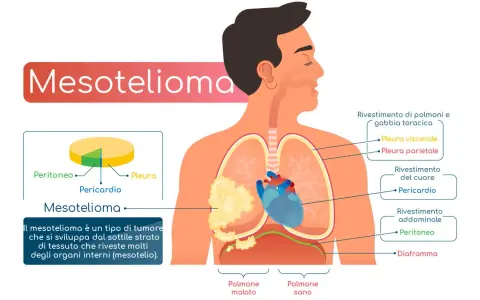Il mesotelioma è un tumore che colpisce il mesotelio, il sottile strato che riveste gli organi interni. L'immagine mostra dove può svilupparsi.