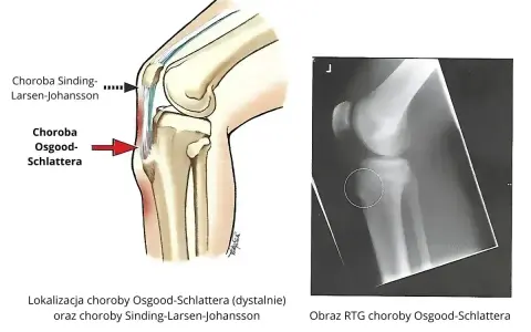 Ilustracja anatomiczna kolana z zaznaczoną chorobą Osgooda-Schlattera i RTG potwierdzające tę chorobę. Rzepka typu 2.