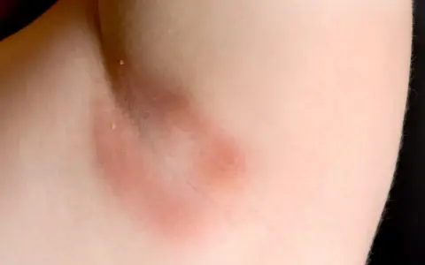 Czerwone plamy pod pachami, zaczerwienienie skóry w okolicy pachy, możliwe podrażnienie.