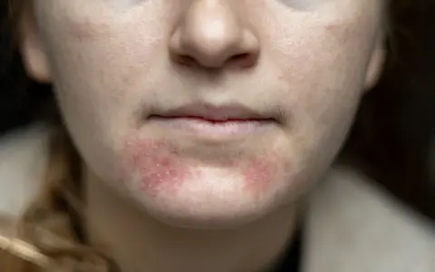 Gesichtshaut spannt extrem? Ursachen & Soforthilfe vom Experten
