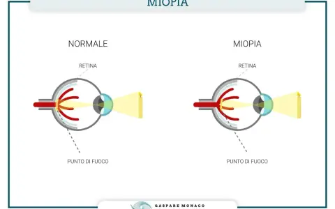Confronto tra occhio normale e occhio miope: nella miopia, il punto di fuoco cade prima della retina, rendendo la visione sfocata.