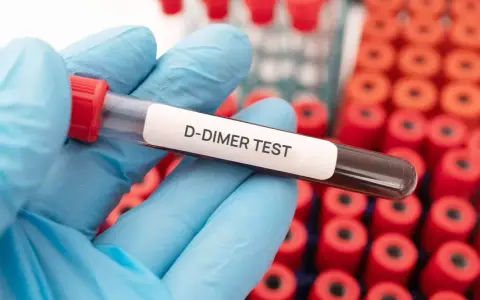 Rękawiczka trzyma probówkę z oznaczeniem "D-DIMER TEST". W tle widać wiele innych probówek. Podwyższone d-dimery mogą wskazywać na zakrzepicę.