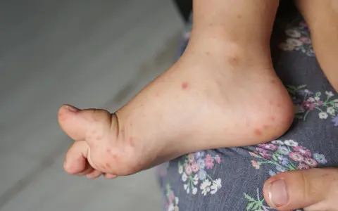 Kiedy dziecko może wrócić do przedszkola po bostonce? Sprawdź teraz