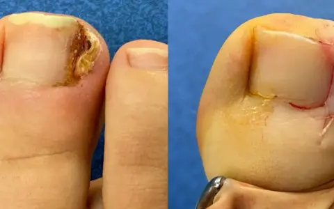 Avant/après chirurgie d'un ongle incarné douloureux par un podologue. Le pied gauche montre l'ongle abîmé, le droit, après intervention, suturé.