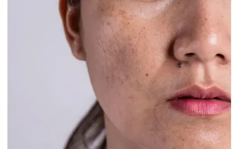 Nahaufnahme eines Gesichts mit sichtbarem Melasma über der Oberlippe und dunklen Flecken.