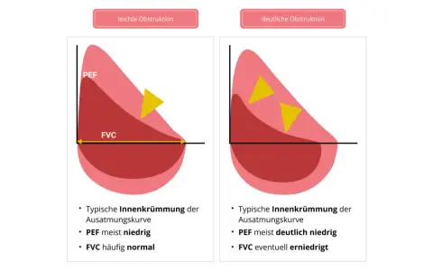 Diagramm zeigt Lungenfunktion bei Asthma. Links leichte Obstruktion mit PEF meist niedrig, rechts deutliche Obstruktion mit PEF deutlich niedrig.