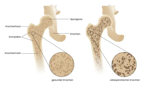 Vergleich gesunder und osteoporotischer Knochen. Rauchen kann Osteoporose fördern, indem es die Knochendichte verringert.