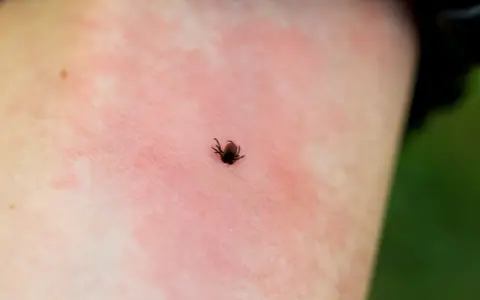 Kleszcz na zaczerwienionej skórze dziecka, po spacerze w lesie.