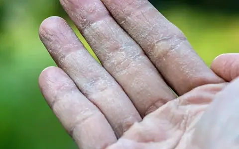 Dedos con piel seca y escamosa, similar a ampollas en los pies por sudor.