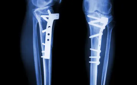 RTG kolan po zabiegu osteotomii guzowatości kości piszczelowej. Widoczne zespolenia płytami i śrubami.