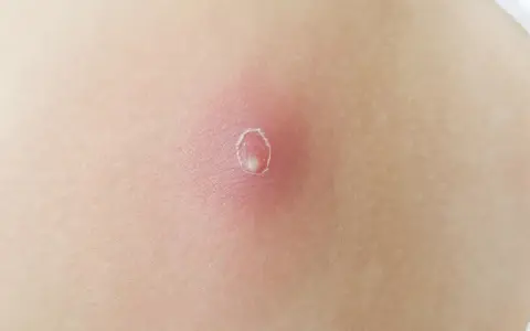 Rote, entzündete Haut mit einem kleinen, weißen Eiterkopf in der Mitte. So sieht ein Abszess aus, wenn er sich bildet.