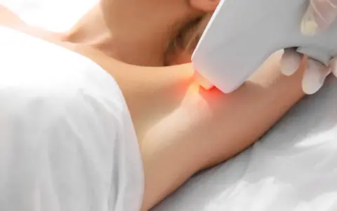 Epilacja laserowa co to – skuteczna metoda trwałego usuwania włosów