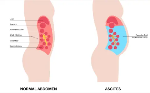 Ilustracja porównująca prawidłowy brzuch z brzuchem z wodobrzuszem (ascites), pokazująca nagromadzenie płynu.