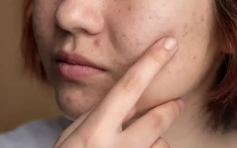 Primo piano del viso di una persona con numerosi brufoli rossi visibili sulla guancia e sul mento.