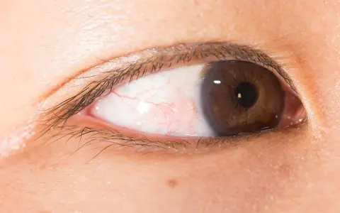 Occhi marroni con sclera arrossata e piccole mosche bianche visibili.