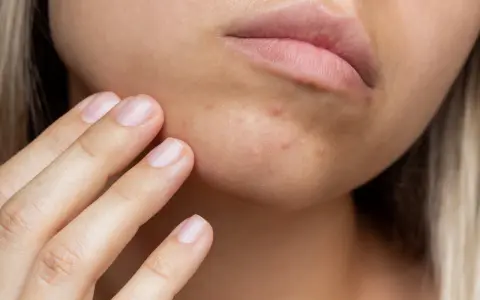 Primer plano de una mujer tocándose la barbilla, mostrando algunos granos en la barbilla.
