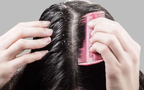 Hände kämmen dunkles Haar, das sichtbare Schuppen zeigt. Die trockene Kopfhaut ist deutlich zu erkennen.