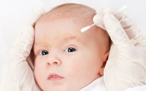 Delikatne dłonie w rękawiczkach pomagają usunąć ciemieniuchę na brwiach niemowlęcia.