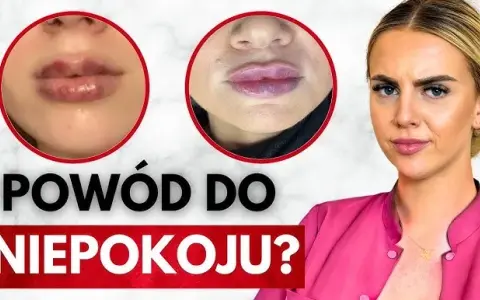 Kiedy schodzi opuchlizna po kwasie hialuronowym? Sprawdź, co robić