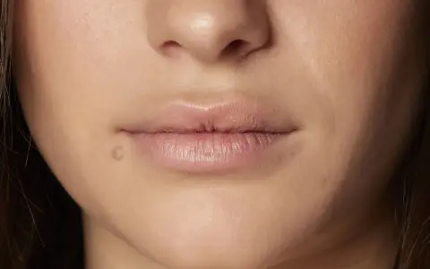 Labios con una pequeña marca, buscando un remedio casero para labios cortados.