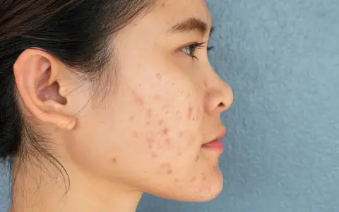 Profil d'une jeune femme avec des marques d'acné sur le visage. Des conseils sur comment enlever les cicatrices d'acné peuvent aider à retrouver une peau nette.